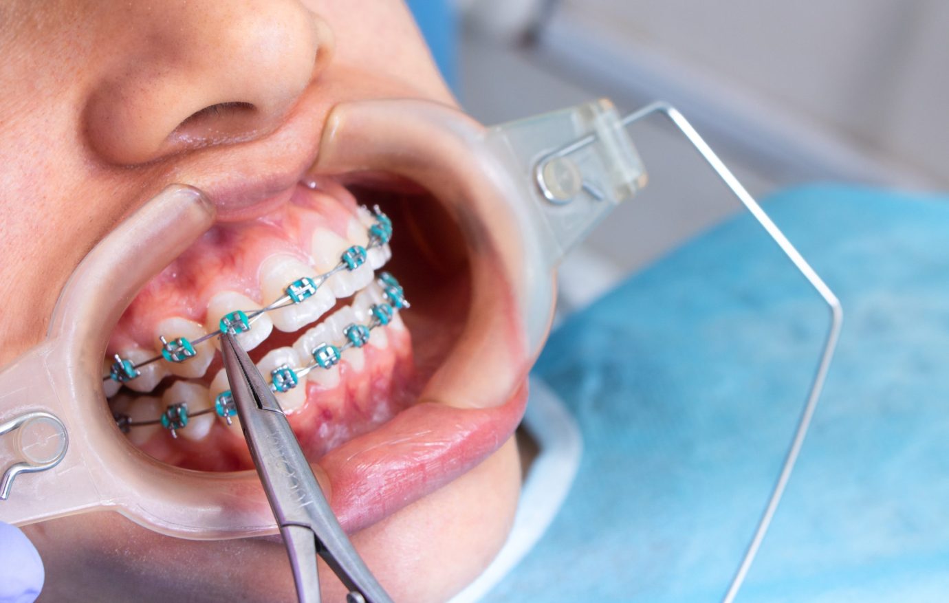 A high angle shot of a doctor fixing the patient's braces using dental equipment